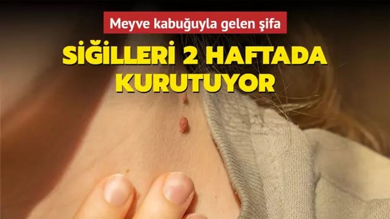 Siğiller ve Muz Kabuğu Tedavisi