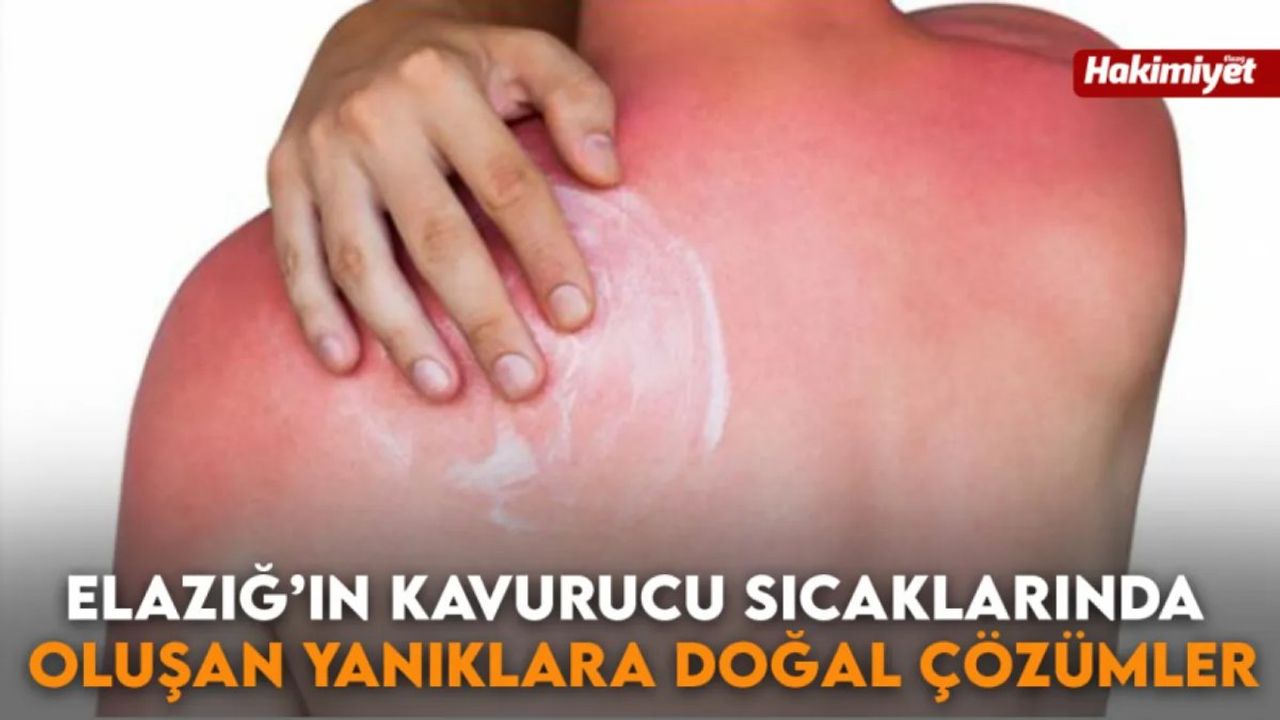 Güneş Yanığına Karşı Etkili Evde Yöntemler