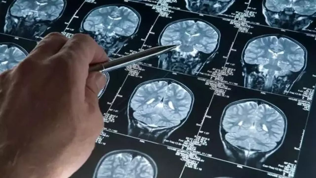 Alzheimer Hastalığına Karşı Yeni Umut: Leqembi