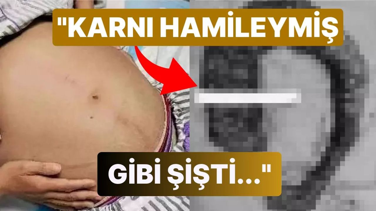 Kabız Kadının Ameliyat ile Alınan Devasa Dışkısı Doktorları Hayrete Düşürdü