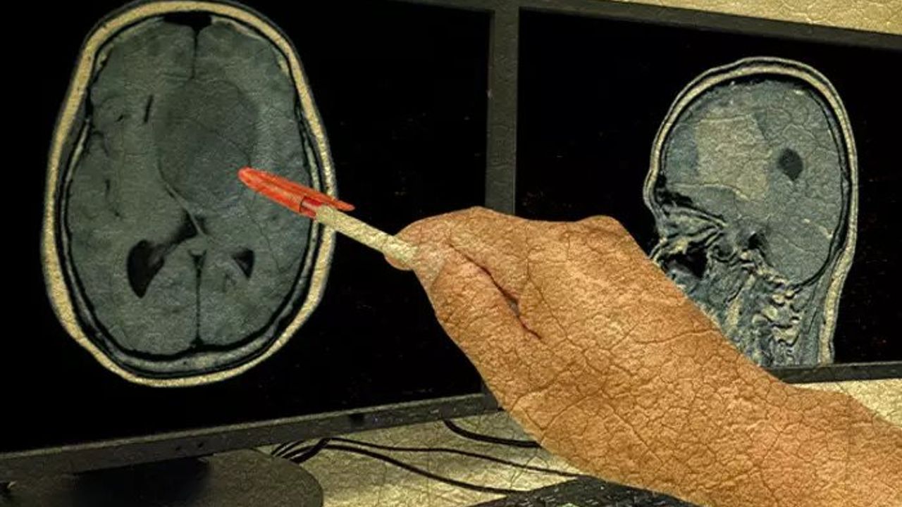 Felçli Kadın Yeni Bir Yapay Zeka İmplantıyla Konuşma Yeteneğini Geri Kazandı