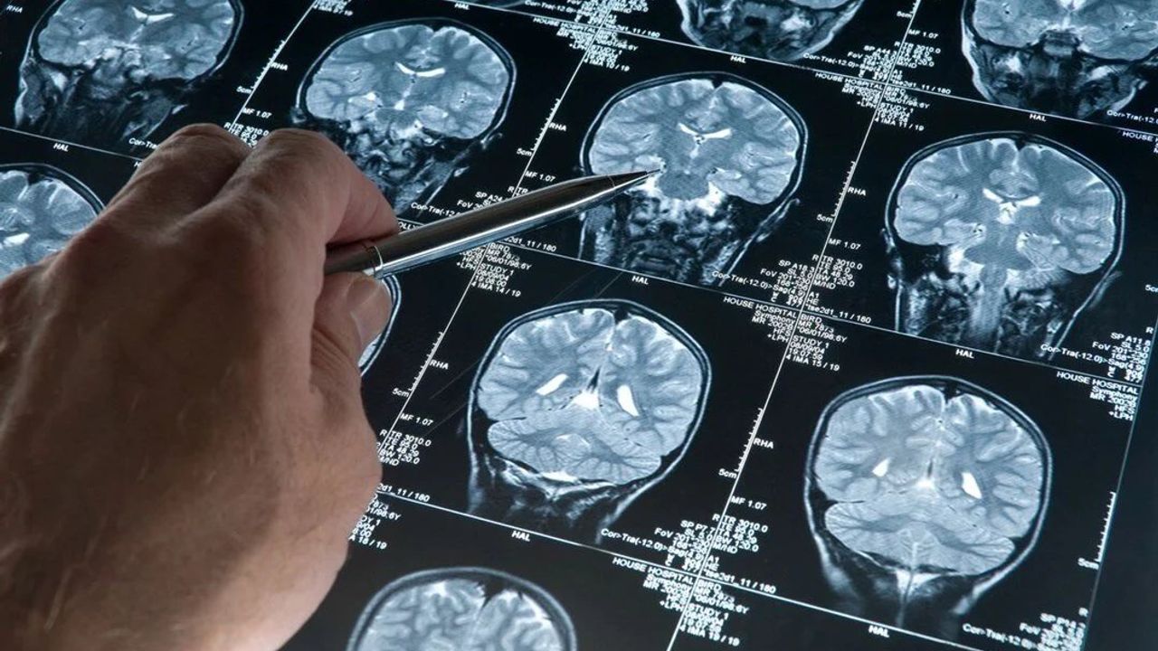 Alzheimer Hastalığının Beyin Hücrelerine Etkisi: Amiloid ve Tau Proteinleri