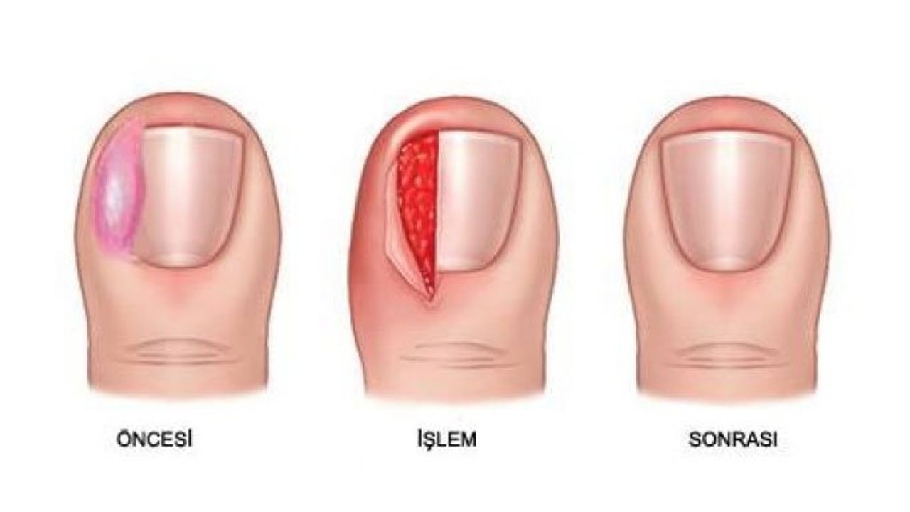 Ayak Parmaklarında Tırnak Batması ve Tedavisi