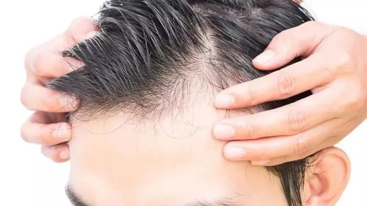 Saç Dökülmesi ve Zoofilik Mantar Enfeksiyonları