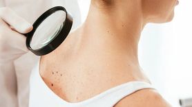 Cilt Kanseri Vakalarında Artış: Uzmanlar Uyarıyor