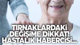 Tırnaklardaki Değişimler Demansın İlk Belirtileri Olabilir