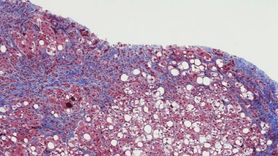 Karaciğer Yağlanması ve Beslenme