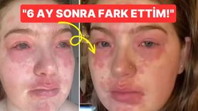 Erkek Arkadaşına Alerjisi Olduğunu İddia Eden Kadın