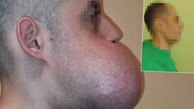 Büyüyen Tümörü ile Yaşayan Genç Adamın Yüzü Yeniden İnşa Edildi