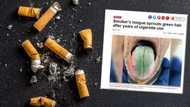 64 Yaşındaki Hastada Nadir Görülen Yeşil Dil ve Tüylenme Sorunu