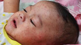 Anne-babalar Dikkat! Kızamık Vakaları Artıyor