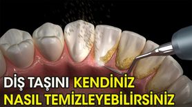 Evde Diş Taşı Temizliği Nasıl Yapılır?