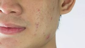 Sivilce Lekelerinden Kurtulmanın Yolları