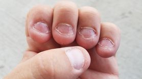 Tırnak Yeme Hastalığının Zararları ve Tedavisi