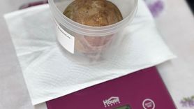 Giresun'da Mesaneden 370 Gram Taş Çıkarıldı