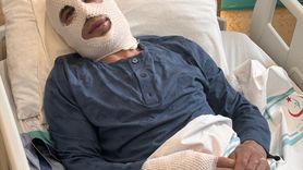 Erzurum'da Sprey Boya Tüpü Patladı, Genç Ağır Yaralandı