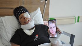 Kadın, Kezzap Saldırısından Sonra Hayata Dönmek İçin Mücadele Ediyor