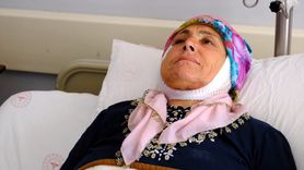 Kısmi Yüz Felci Ameliyatı ile Sağlığına Kavuştu