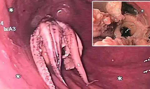 Singapur'da Ahtapot Yedikten Sonra Hastanelik Olan Adamın İlginç Hikayesi