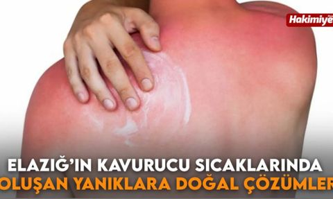 Güneş Yanığına Karşı Etkili Evde Yöntemler