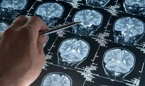 Alzheimer Hastalığına Karşı Yeni Umut: Leqembi