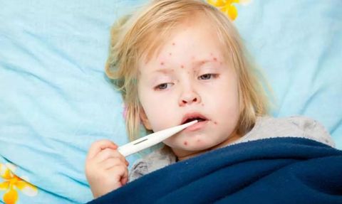 Kızamık Vakalarında Artış: Korunma Yolları ve Belirtiler