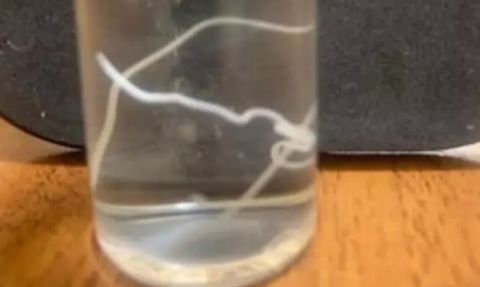 Rusya'da Şaşırtıcı Bir Olay: Baş Ağrısının Sebebi Solucan Çıktı