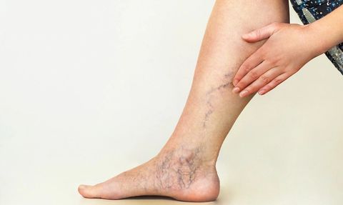 Varisli Damarlardan Kurtaran Etkili Kür