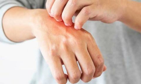 Alfa-gal Sendromu: Kene Isırığıyla Tetiklenen Et Alerjisi