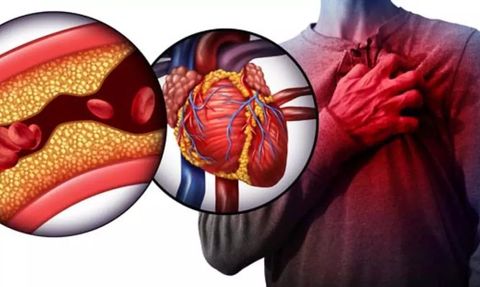 Aort Anevrizması ve Hayati Riskleri