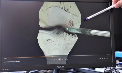 Diz Kireçlenmelerine Ameliyatsız Çözüm: Hidrojel Tedavisi Geliştirildi