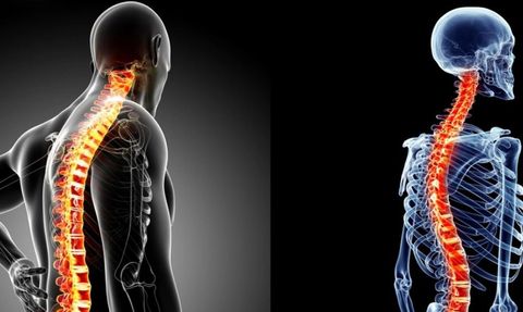 Skolyoz (Omurga Eğriliği) Nedir?
