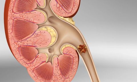 Böbrek Taşları ve Önleme Yöntemleri