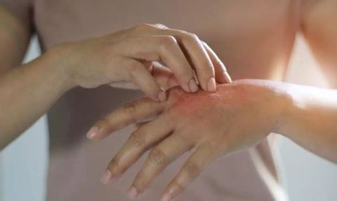 Sedef Hastalığı: Belirtileri, Tedavisi ve Yaşam Kalitesi