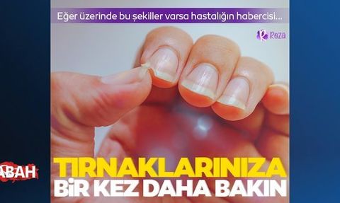 Tırnak Yemek: Nedenleri ve Tedavisi