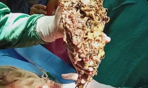 Hindistan'da Kadının Midesinden Çıkan Metal Şoke Etti