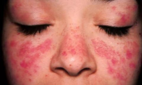 Pozitif Lupus Hastalığı Nedir? Belirtileri ve Tedavisi