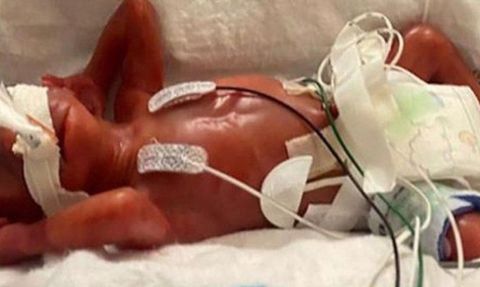 Dünya Genelinde 2020'de 13,4 Milyon Bebek Prematüre Doğdu