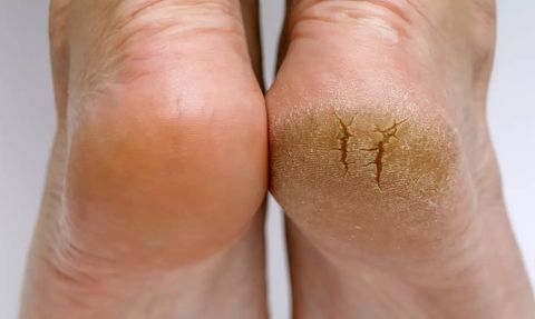 Topuk Çatlağını Yumuşatmanın Doğal Yolları