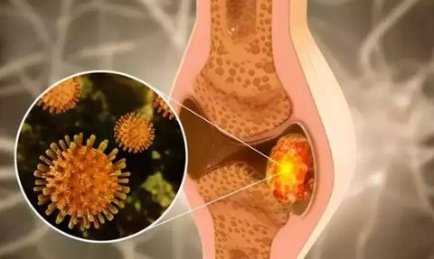 Kemik Erimesi ve Beslenme: Sağlıklı Kemikler için Hangi Besinler Tüketilmeli?