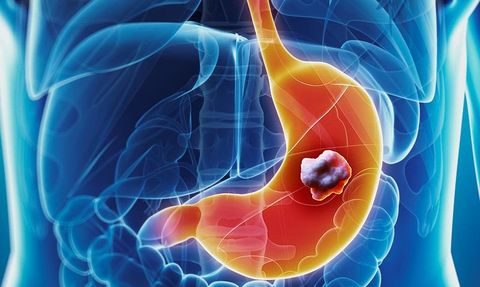 Sindirim Sistemi Hastalıkları ve Tedavi Yöntemleri