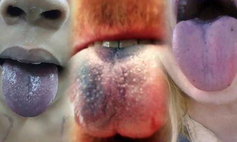 Mavi Dil Salgını: Etkili Bir Aşıya İhtiyaç Var