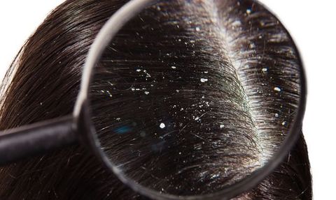 Saç Kepeği ve Parkinson Hastalığı Arasındaki İlişki