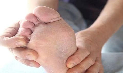 Ayağındaki sorunlardan şikayetçi olanlar... Belki bu hastalıklara sahipsinizdir! Mutlaka doktora gidin