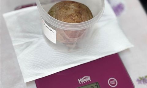 Giresun'da Mesaneden 370 Gram Taş Çıkarıldı