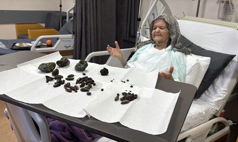 92 Yaşındaki Kadın Zeytin ve Hurma Çekirdekleri Nedeniyle Ameliyat Oldu