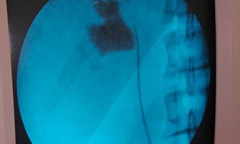 Kırşehir'de Başarılı Kapalı Ameliyatla Böbrek Taşı Çıkarıldı