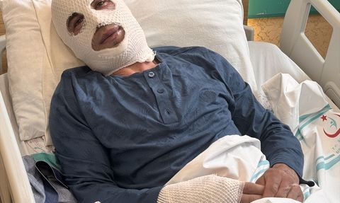 Erzurum'da Sprey Boya Tüpü Patladı, Genç Ağır Yaralandı