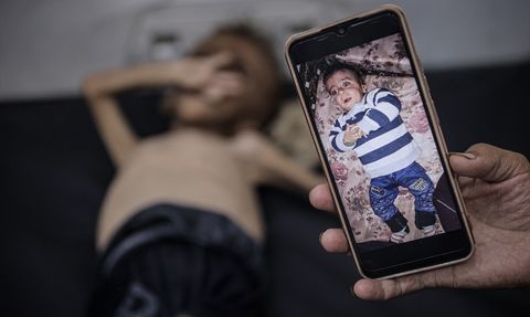 Gazze'deki Şiddetli Açlık: Filistinli Bebek ve Doktorun Açıklamaları