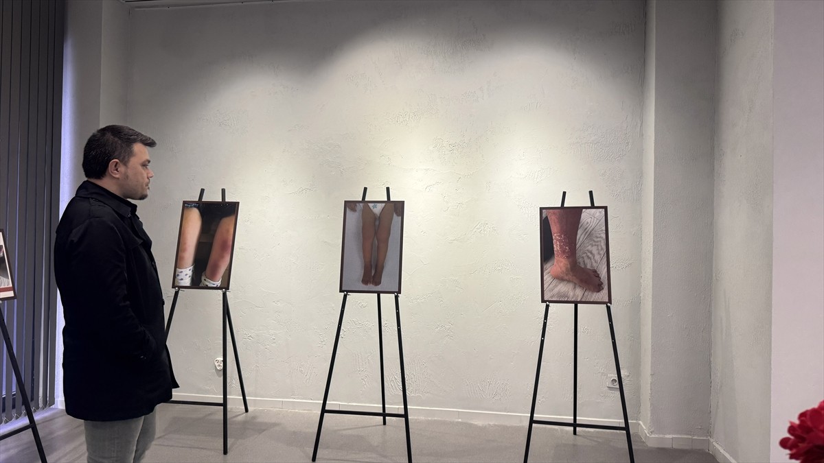 Kayseri'de, Erciyes Üniversitesi (ERÜ) İç Hastalıkları Romatoloji Bilim Dalı öğretim üyelerince...